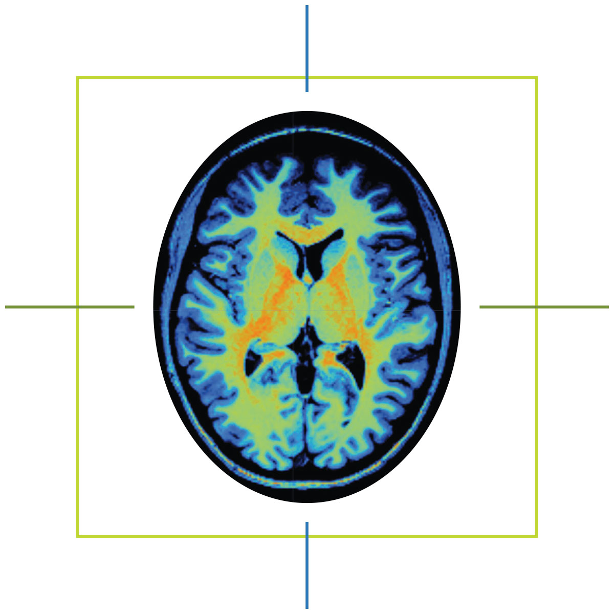 A scan of a brain with a raket surrounding it.